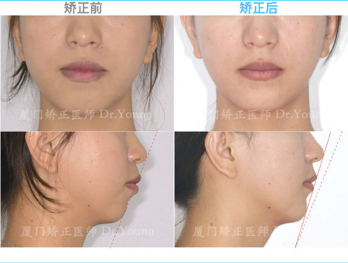 上颌前突下颌后缩是骨性还是牙性,厦门牙齿凸嘴矫正