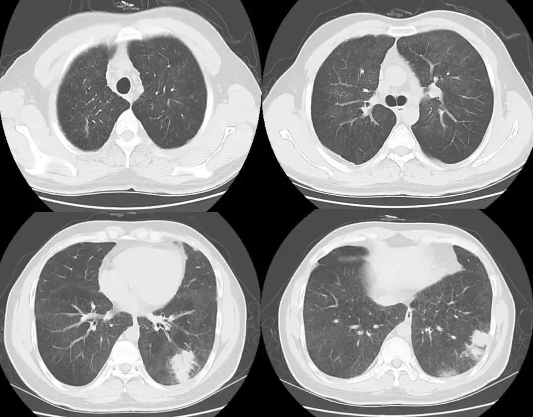 青年男性肺炎过后一直咳嗽怎么办,潜伏结核感染咳嗽咳痰
