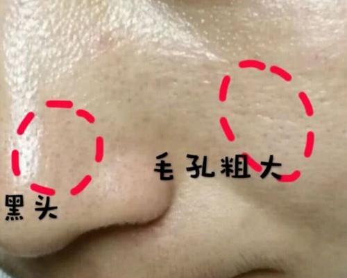 毛孔粗大起皮底妆,毛孔粗大皮肤显得粗糙