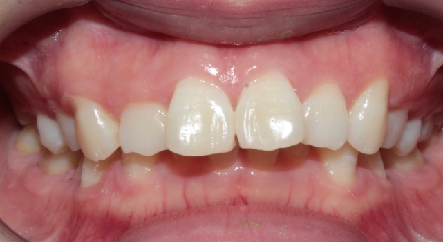 南京牙齿矫正内倾,南京牙齿矫正比较好的医院有哪些