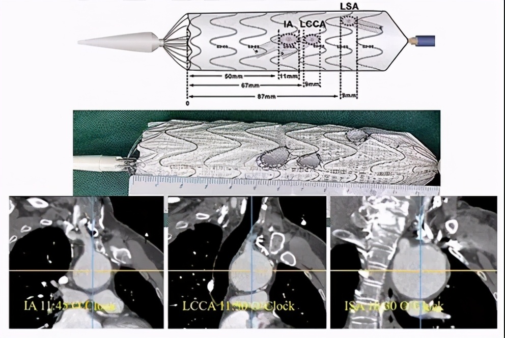 胡佳：升主动脉近端手术后新发弓部病变的腔内治疗