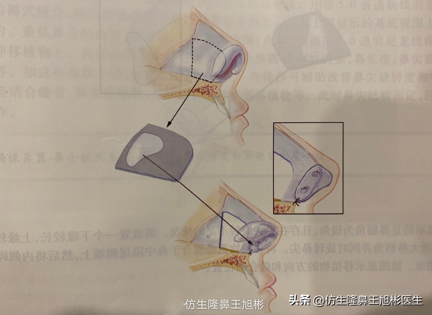 鼻中隔重塑鼻头,鼻中隔重建整形
