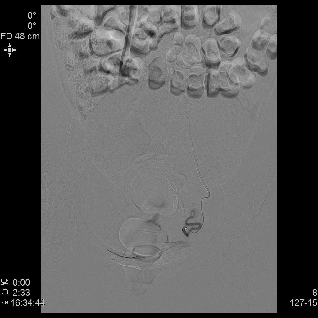 子宫肌瘤介入栓塞对子宫影响,子宫肌瘤介入栓塞治疗的危害