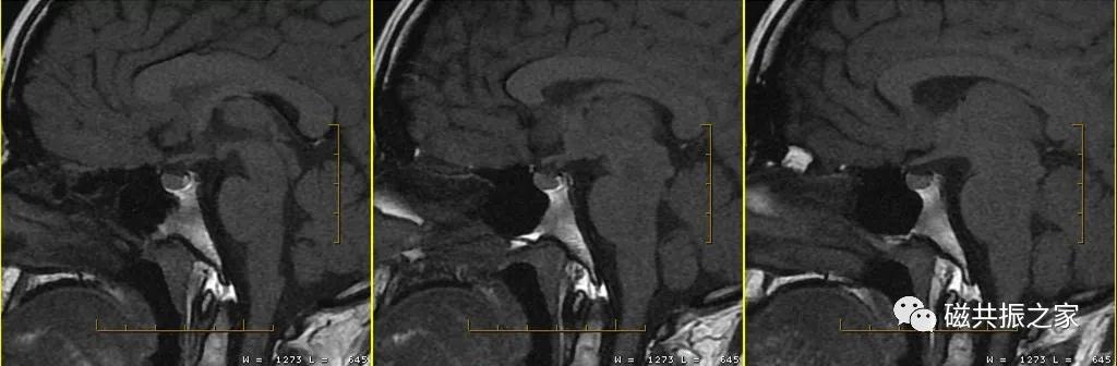 垂体mri扫描,垂体微腺瘤mri扫描