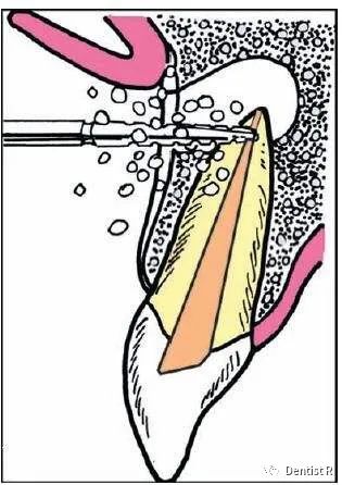 有烂牙但是不痛能直接补牙吗,烂牙不痛还要去补牙吗