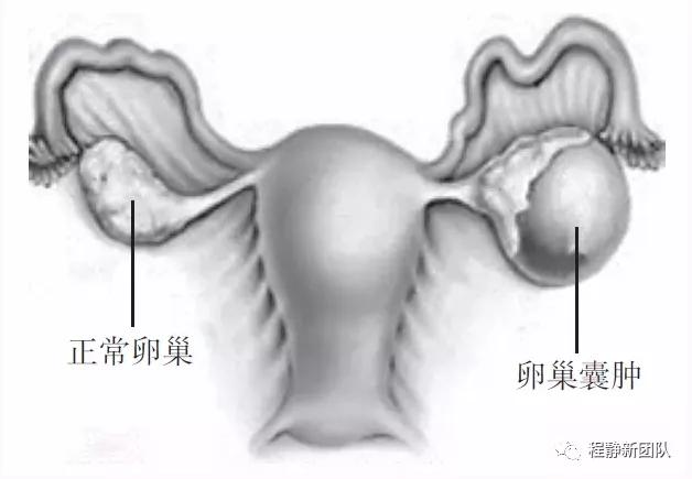 老年人发现卵巢囊肿怎么处理,更年期有卵巢囊肿可怕吗