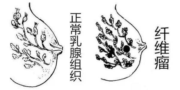 乳腺纤维瘤可能是奶块吗,乳腺纤维瘤有可能是乳腺癌么
