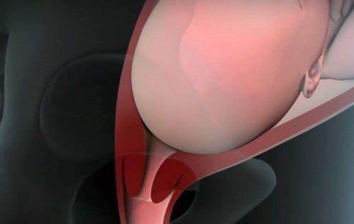 产道那么小怎么顺产,产道那么小胎儿怎么出来的