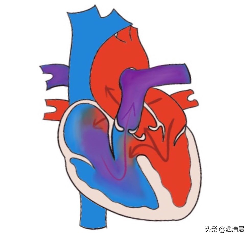 心源性脑栓塞一例引发的思考