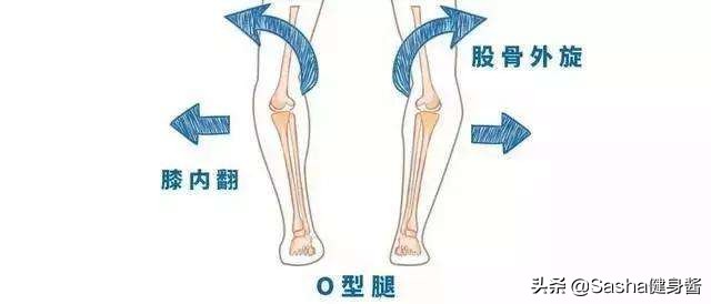 严重o型腿怎么矫正最有效的动作,正确矫正o型腿的方法