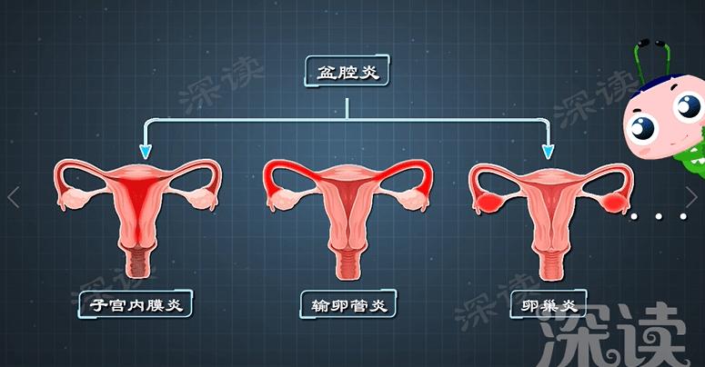 有盆腔炎是不是白带不正常,盆腔炎为什么会白带异常