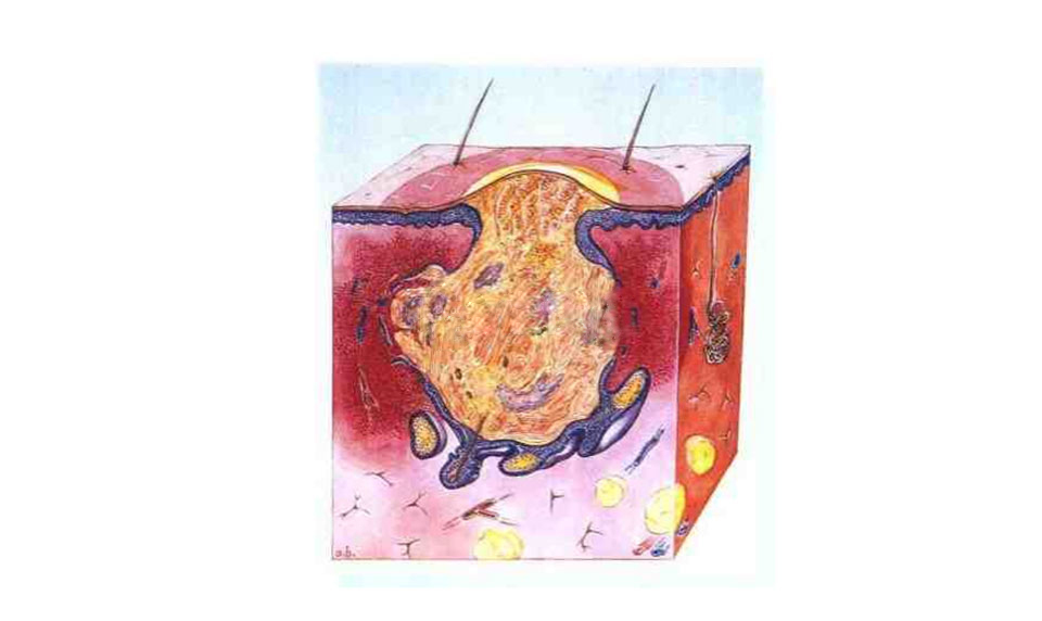 长痘痘的症状有哪些呢,长痘痘的原因及解决方法