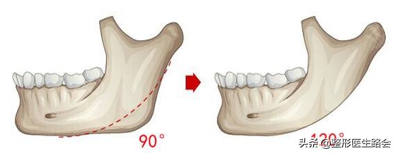 120度的下颌角容易变成方形脸吗,90度下颌角看着好难看啊