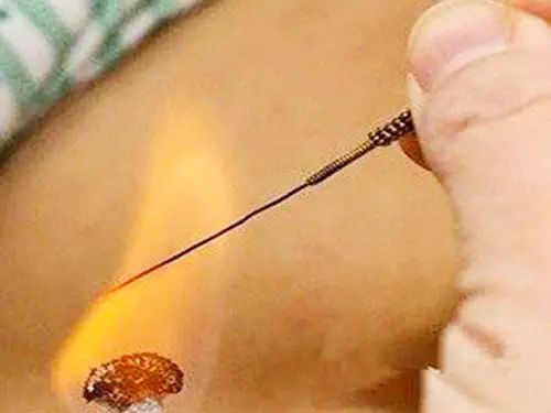 火疗引火烧身,引火归元针治疗三种病