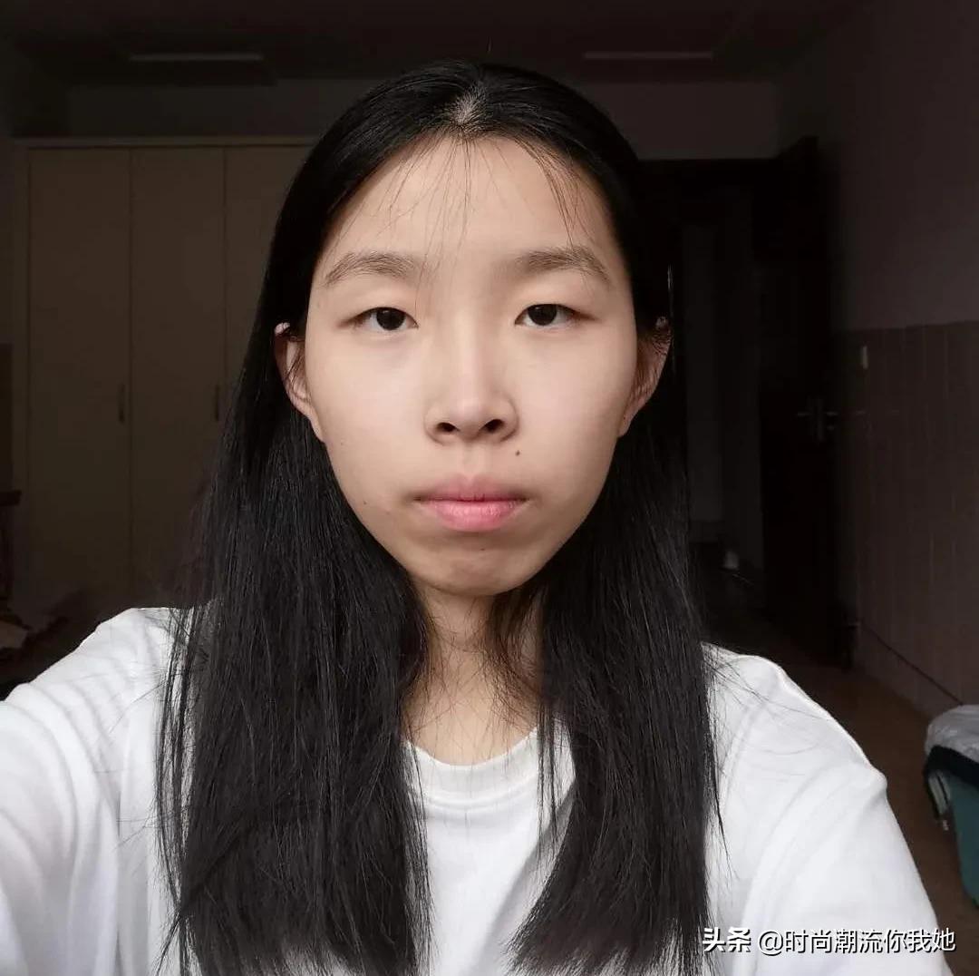 单眼皮凸嘴素人改造,肿眼泡整容成功案例