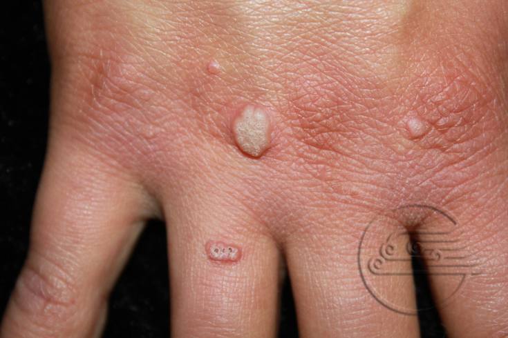 传染性软疣儿童怎么治可以断根,儿童脸上长了传染性软疣怎么办