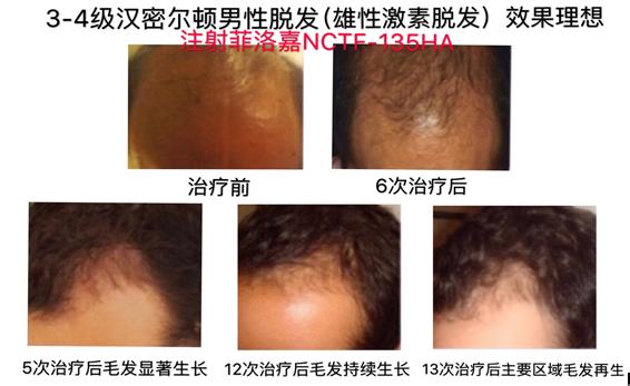 如何挽救脱发,父亲脱发怎么挽救