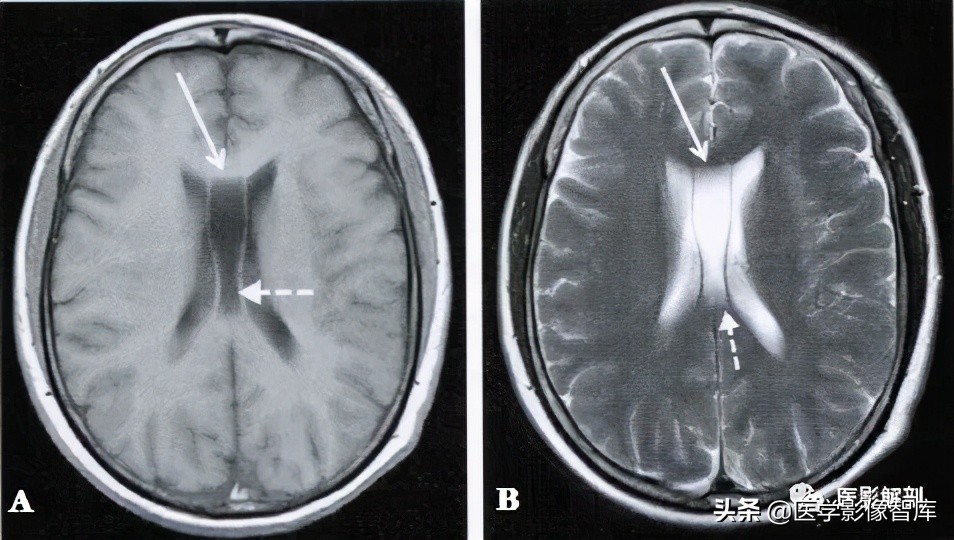胎儿透明隔间腔及vergae腔,透明隔间腔及vergae腔需要治疗吗