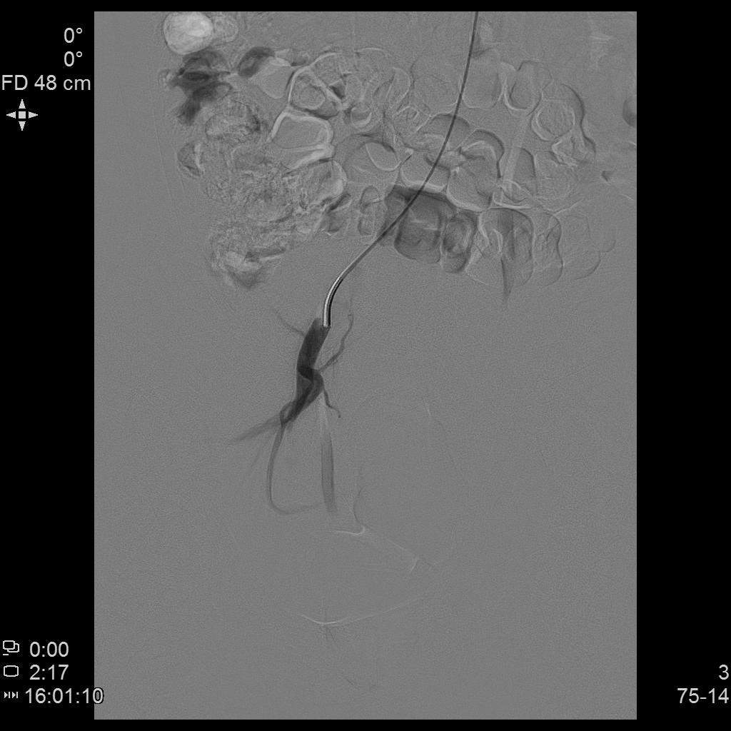 子宫肌瘤介入栓塞对子宫影响,子宫肌瘤介入栓塞治疗的危害