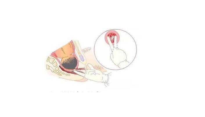 宫缩开一指到10指有多痛,宫缩一到十指的疼痛程度