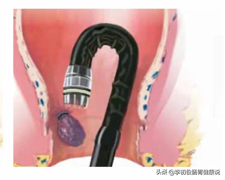 一次无痛胃肠镜一共需要多久,一次做完胃肠镜