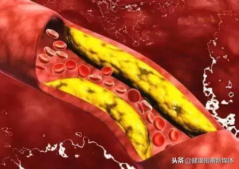 新生儿血小板减少症,血栓性血小板减少症