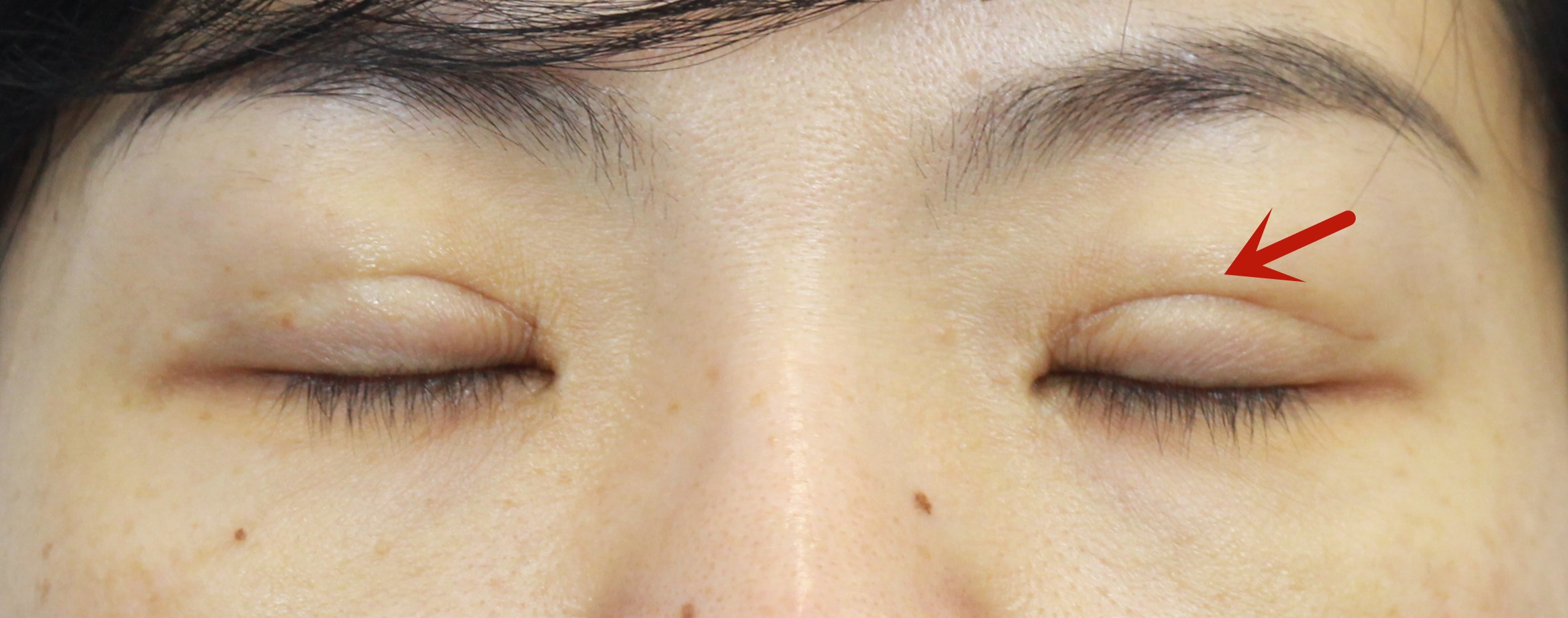 双眼皮术后出现肉条怎么办,双眼皮肉条感修复手术痛吗