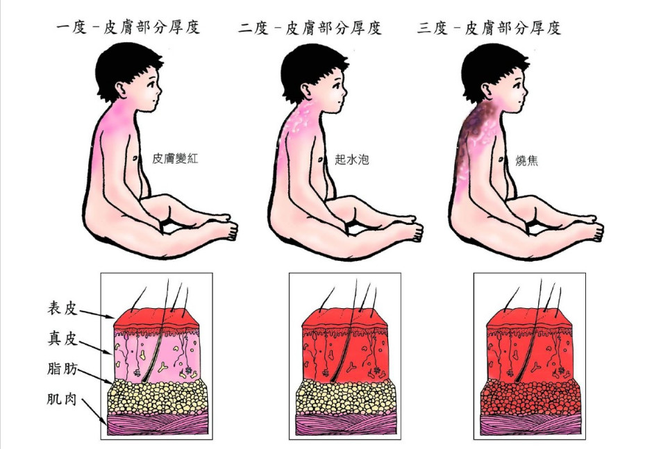 烧烫伤小科普,高温烫伤处理方法以及关注事项