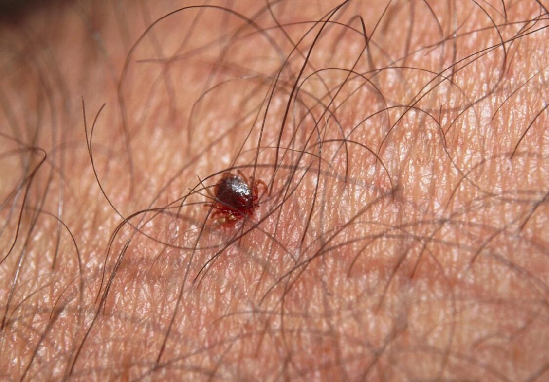 蜱虫咬到孩子之后会出现什么症状,蜱虫虽小危害大一旦被咬如何处置