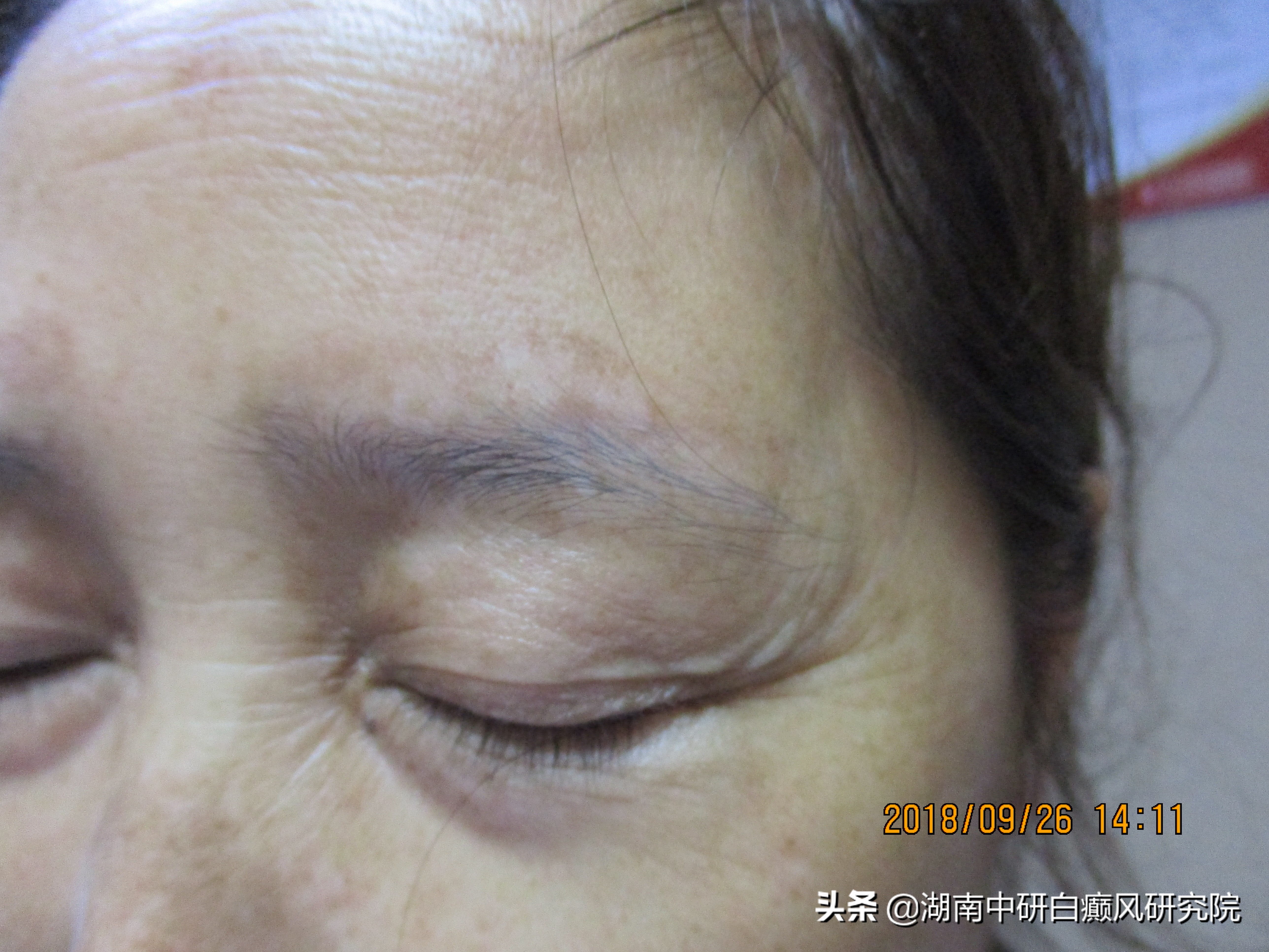 一位面部白癜风的患者，从患白到康复，她经历了什么？