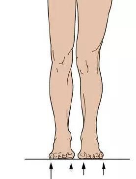 体态不好说明脊柱侧弯吗,骨盆倾斜造成哪些体态问题