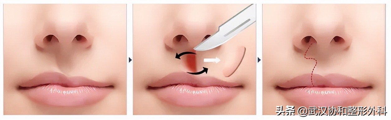 常见的唇部整形都有哪些,常见的唇部整形有哪些