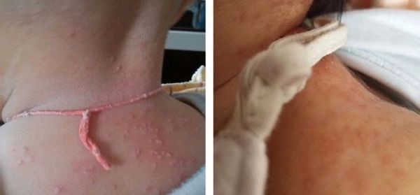 宝宝脖子上的痱子起脓包,痱子发红是快好了吗