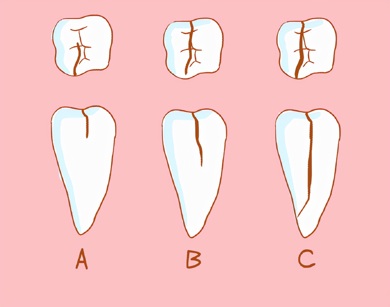 牙齿酸软中医最快解决办法,牙齿酸软怎么治最好的办法
