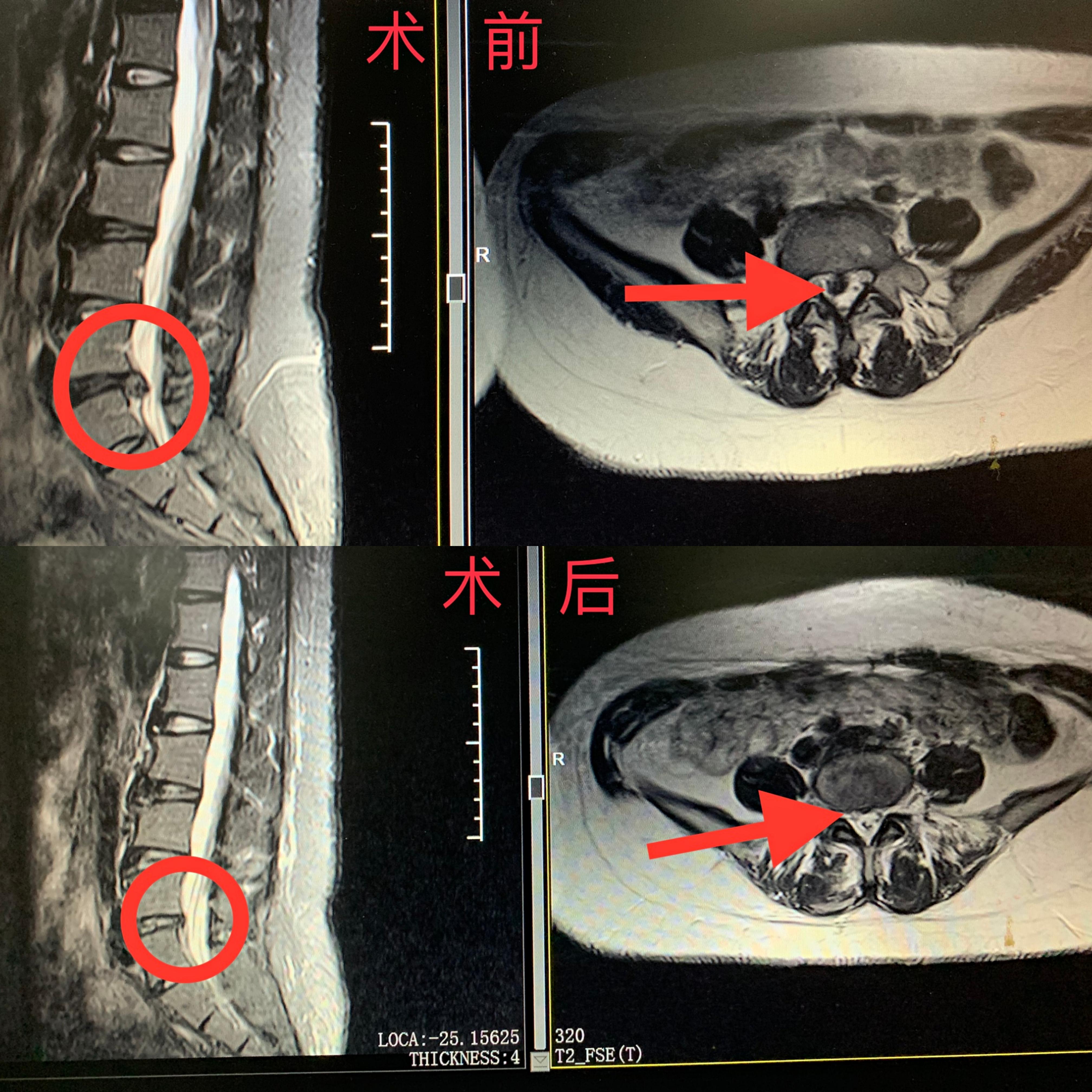 蒙城中医院腰椎间盘突出微创,孙逸仙医院腰椎间盘突出微创费用