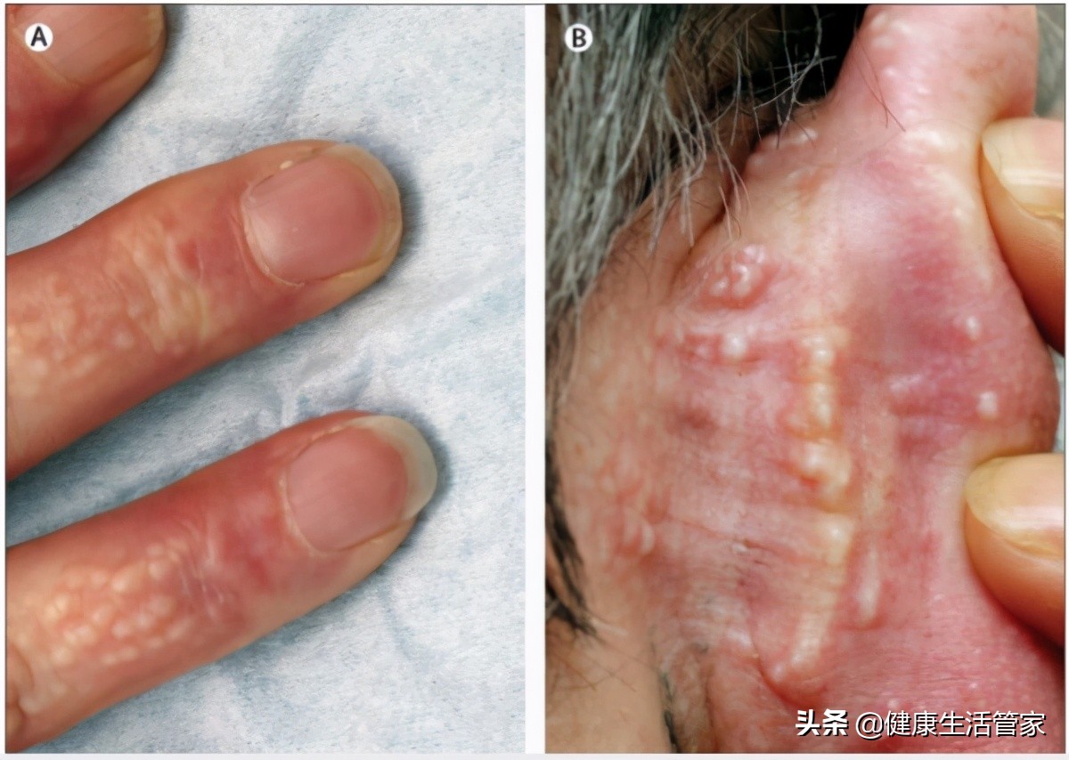 浆液性水肿的症状,77岁女性颜面及双下肢水肿