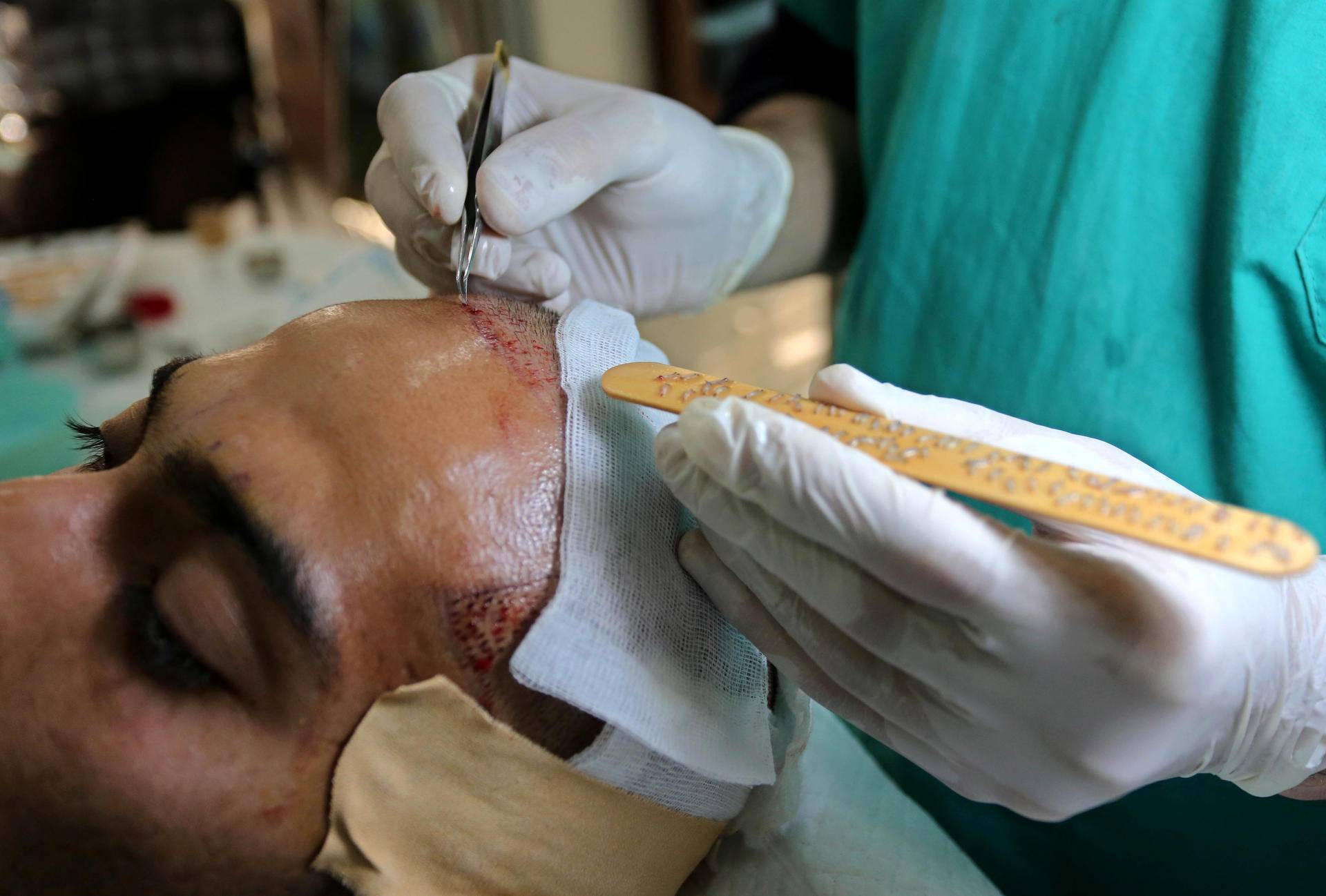 植发培训三天速成班,植发培训班真实感受