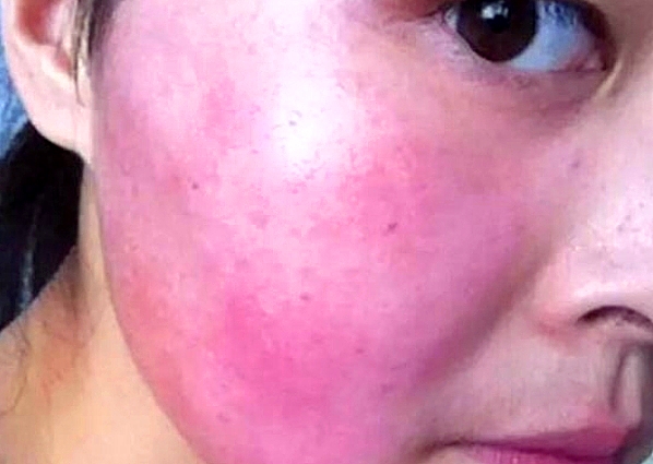 戴口罩过敏脸上发红发痒起疙瘩,戴口罩脸部出现红肿该如何处理