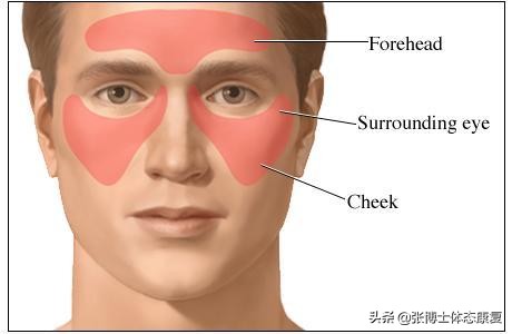 头痛康复锻炼方法,运动导致的头痛怎么缓解
