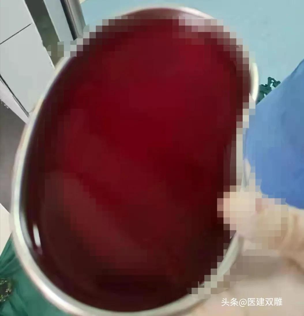 病例分享案例,硬膜下血肿病例