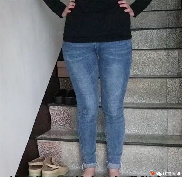 走路屁股扭来扭去是种病，还会导致腰痛、脚痛