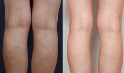 腿上爆青筋是静脉曲张吗,腿上爆出青筋是静脉曲张吗