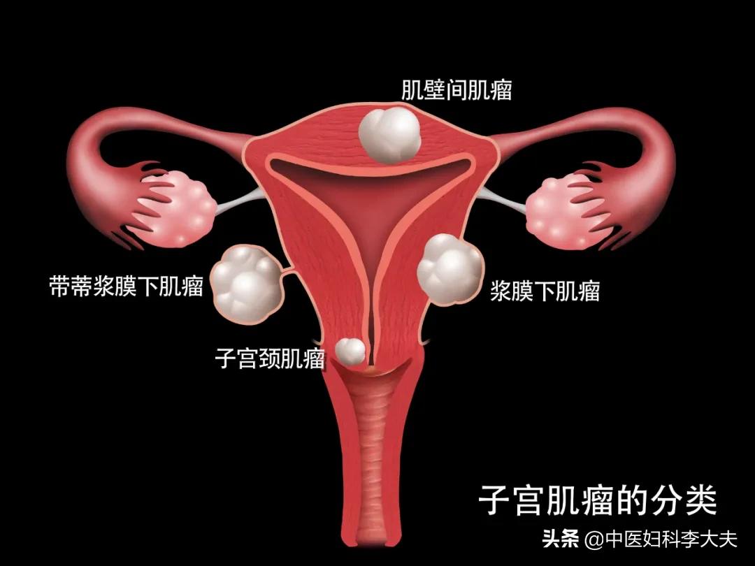 子宫腺肌症子宫增大怎么办,子宫增大是什么原因引起的