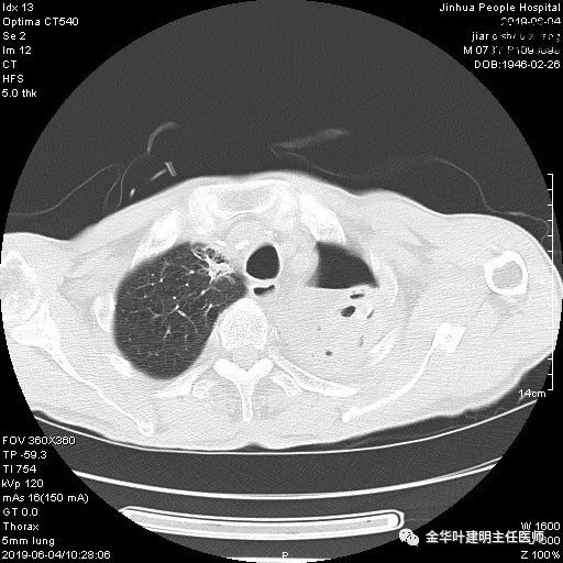 肺手术后乳糜胸是医疗事故吗,肺部切除后乳糜胸治好了