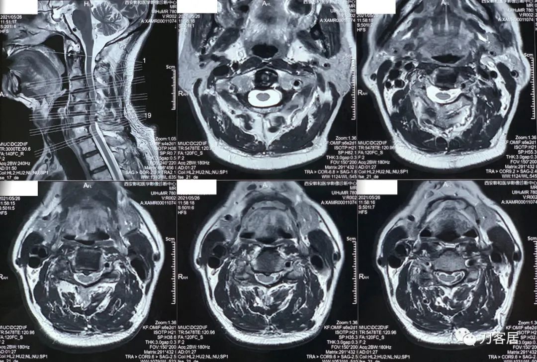 颈椎病椎间盘突出医生说先不手术,颈椎3-7节椎间盘突出怎么治疗
