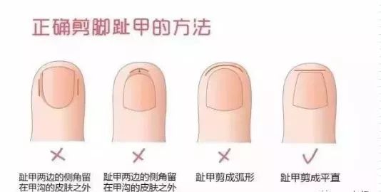 娃指甲上有白点是怎么回事,孩子指甲横纹有白点