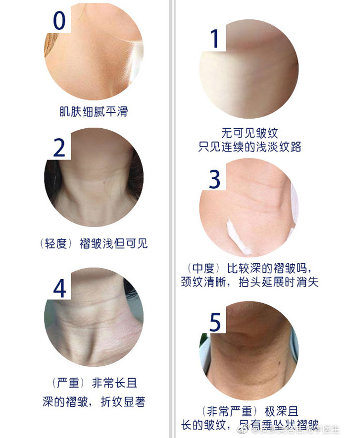 嗨体去颈纹自己能操作吗,嗨体填充颈纹的副作用和危害