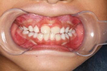 8岁的孩子能做牙齿矫正吗,7岁孩子矫正牙齿早吗