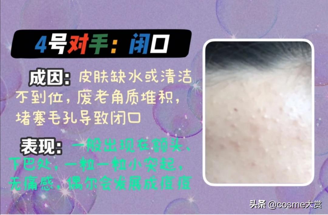 脸上粉刺闭口痘印瑕疵用什么,皮肤暗黄粗糙瑕疵痘痘闭口