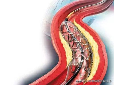 保守治疗还需用戴支架吗,放支架一定比保守治疗好吗